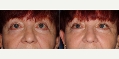 Eyelid Surgery before and after photo