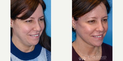 Facelift before and after photo