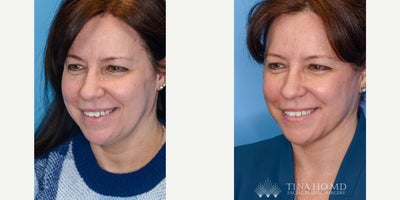 before and after image