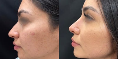 Rhinoplasty before and after photo