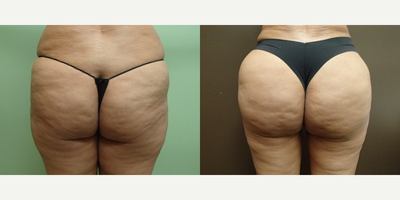 Brazilian Butt Lift before and after photo