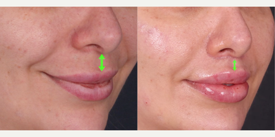 Lip Lift before and after photo