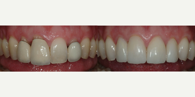 Porcelain Veneers before and after photo