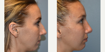 Rhinoplasty before and after photo