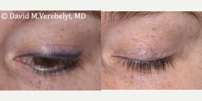 Tattoo Removal before and after photo