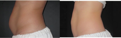 CoolSculpting before and after photo