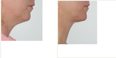 Kybella before and after photo