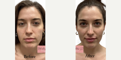 Lip Fillers before and after photo