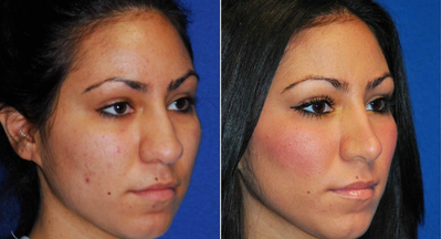 Rhinoplasty before and after photo