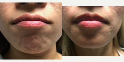 Botox before and after photo