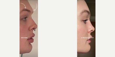Brow Lift before and after photo