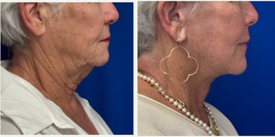 CO2 Laser before and after photo