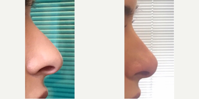 Dermal Fillers before and after photo
