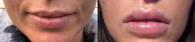 Juvederm before and after photo