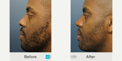 African American Rhinoplasty before and after photo