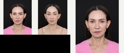 Deep Plane Facelift before and after photo