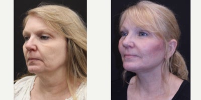 Eyelid Surgery before and after photo