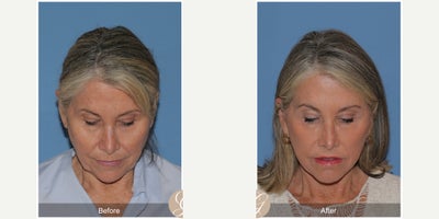 Neck Lift before and after photo