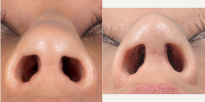 Revision Rhinoplasty before and after photo