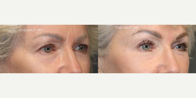 Brow Lift before and after photo
