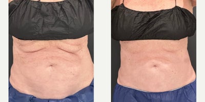 CoolSculpting before and after photo