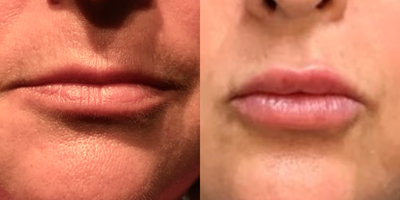 Jeuveau before and after photo