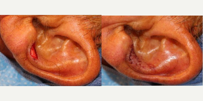 Mohs Surgery before and after photo