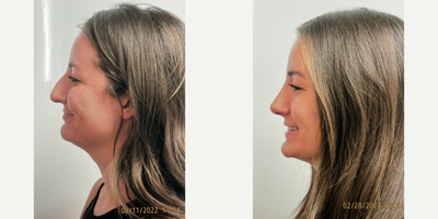 Rhinoplasty before and after photo