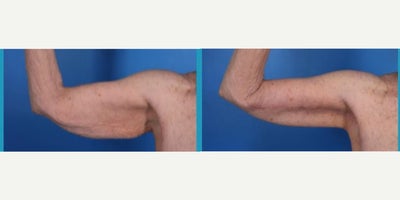 Arm Lift before and after photo
