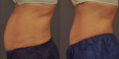 CoolSculpting before and after photo