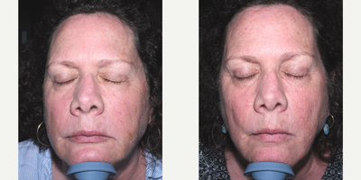 Nonsurgical Facelift before and after photo