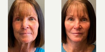 Facelift before and after photo