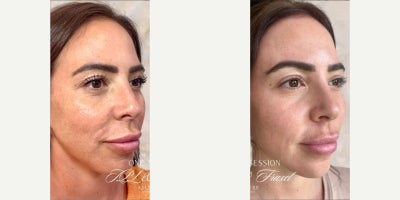 IPL before and after photo
