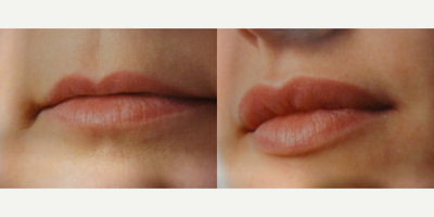 Lip Fillers before and after photo