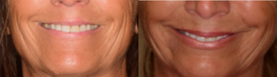 Restylane Refyne before and after photo