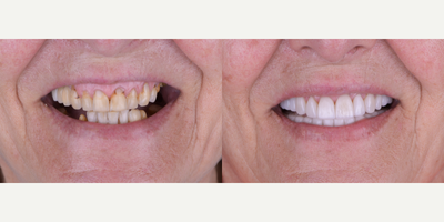 Smile Makeover before and after photo