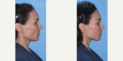 Brow Lift before and after photo