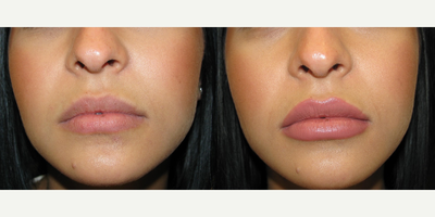 Juvederm before and after photo