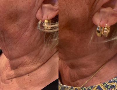 PlasmaPen before and after photo