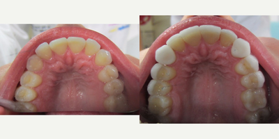 Smile Makeover before and after photo