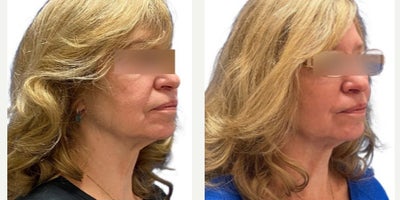 Dermal Fillers before and after photo