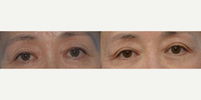 Eyelid Surgery before and after photo