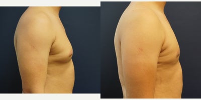 Gynecomastia Surgery before and after photo