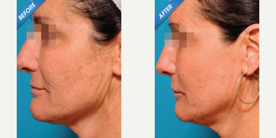 Halo Laser before and after photo