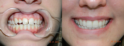 Invisalign before and after photo