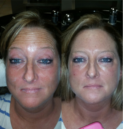 Restylane before and after photo