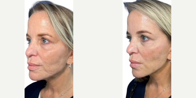 Dermal Fillers before and after photo
