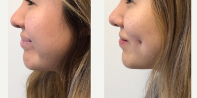 Dimple Surgery before and after photo