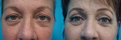 Eyelid Surgery before and after photo