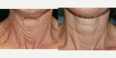 Botox before and after photo